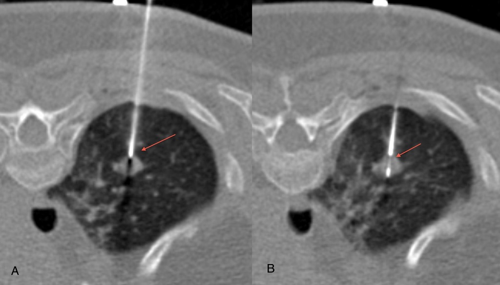 Ct Guided Biopsies Precise Tissue Sampling Procedures In Mumbai