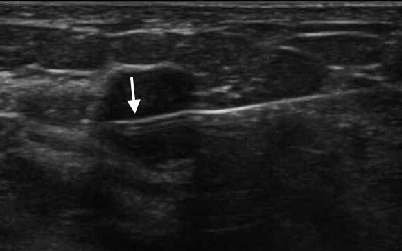 Ultrasound Guided Biopsies Precise Tissue Sampling Procedure In