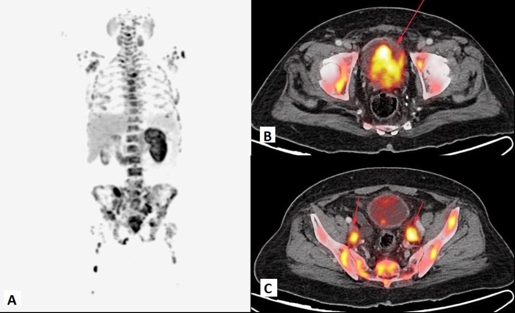 psma-pet-scan-advanced-prostate-cancer-imaging-in-mumbai-india