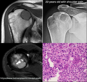 Chondroblastoma of shoulder joint