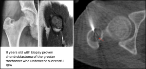 Chondroblastoma of hip joint