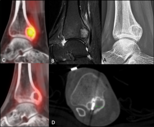 chondroblastoma of tibia bone at ankle joint area