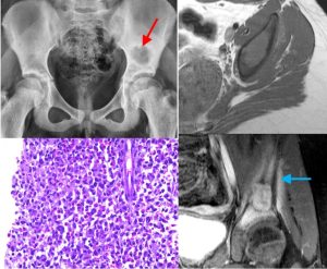 the-concept-of-benign-aggressive-bone-tumors-5