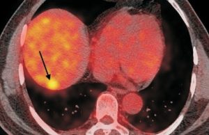 radiofrequency-ablation-of-solitary-liver-metastasis-2