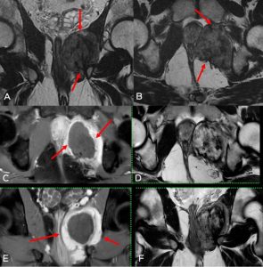 cryoablation-of-pelvic-fibromatosis-3