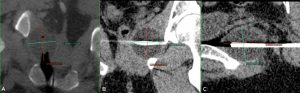 cryoablation-of-pelvic-fibromatosis-5